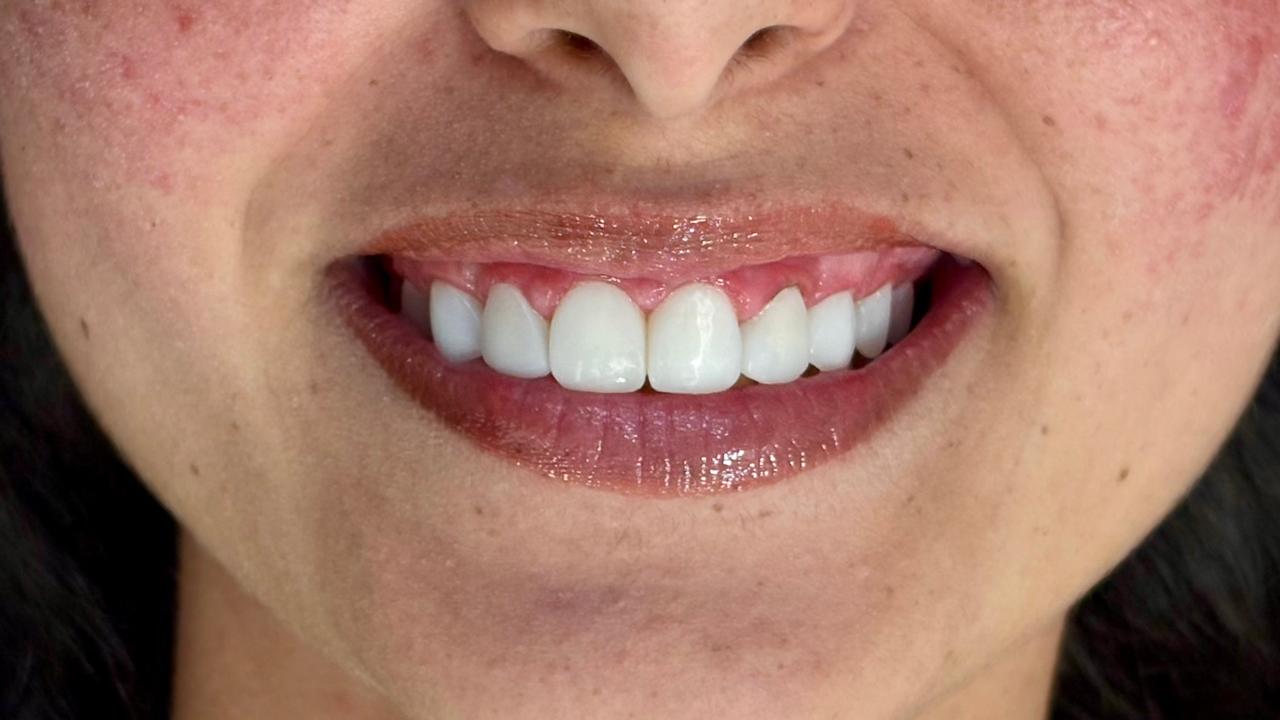 Depois - lentes em resina e plástica gengival