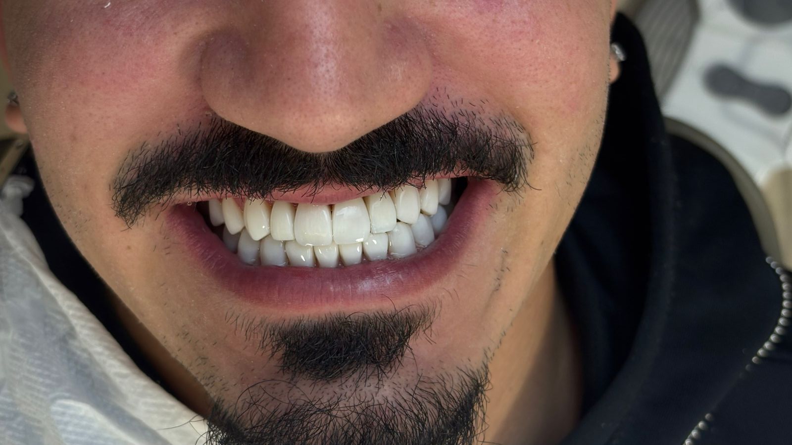 Depois - reabilitação oral estética